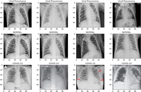 Sample Images Of Chest X Ray Medical Image Dataset Download