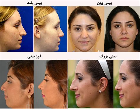 دانستنی های جراحی زیبایی بینی2 انواع عمل زیبایی در خراسان رضوی دکتر حامدی