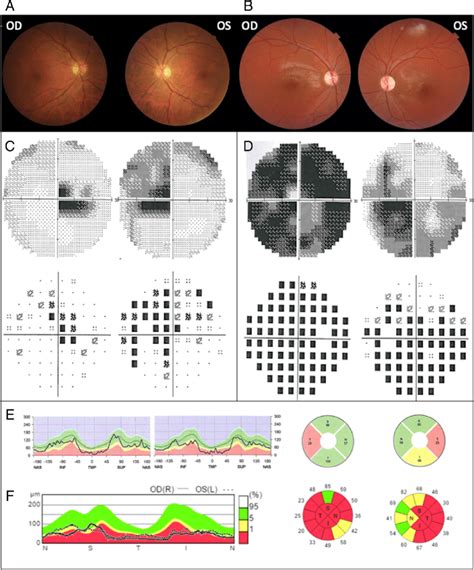 Ophthalmologic Findings Ophthalmologic Features In 2 Patients A Mild