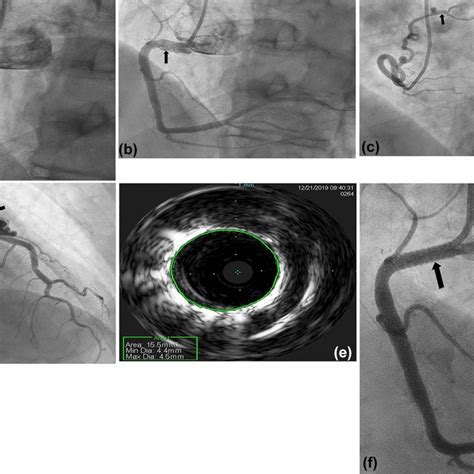 A Coronary Angiogram Left Anterior Oblique View Of Rca Was Notable For