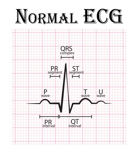 Normal ECG Electrocardiogram Chart 2268232 Vector Art At Vecteezy