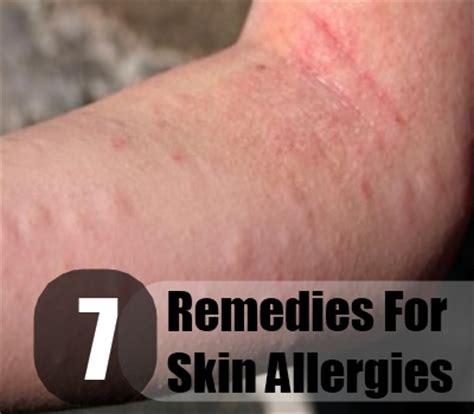 The job of immune system cells is to find foreign substances, such as viruses and bacteria, and get rid of them. Skin Allergies Herbal Remedies, Treatments And Cures ...