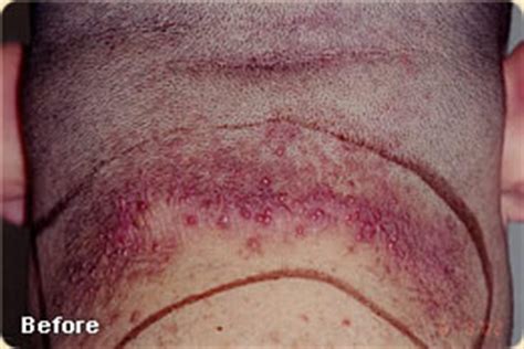 An ingrown hair is a hair that grows under the skin. Ingrown Hair Folliculitis - Dermatology & Laser Surgery ...