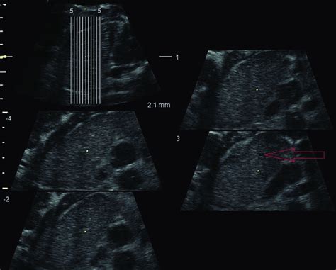 Tui Tomographic Ultrasound Imaging Longitudinal Section Of A Male