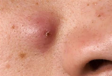 Beulen an den fingern können auch andere bedingungen sein, also ist es wichtig, auf zeichen zu achten, dass etwas ernsteres vor sich geht. Die ganze Wahrheit über Teenager mit Akne | Pickel unter ...