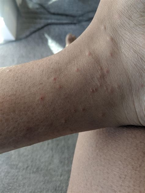 Have these small itchy bumps mainly on my left leg for the last week since returning from Puerto 