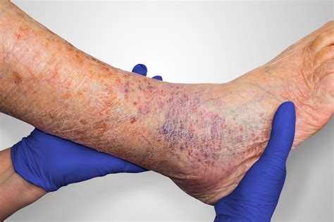 Venous Ulcers Diagnosis And Treatment Laser Vein Clinic