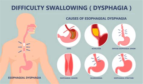 Swallowing Issues Causes And Treatments Dr Stephen Kleid Fracs