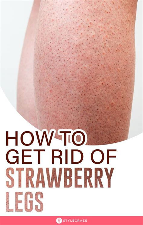10 Natural Ways To Get Rid Of Strawberry Legs Strawberry Legs