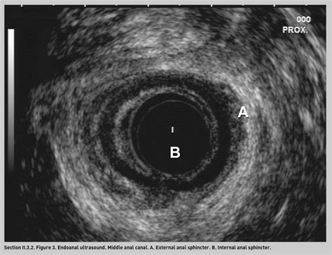 Geteccu Endi Ii32 Endoanal Ultrasound In Perianal Disease