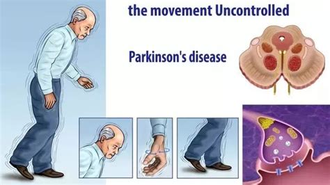手抖不是帕金森病的专利出现这些症状也需警惕 帕金森 患者 症状 新浪新闻