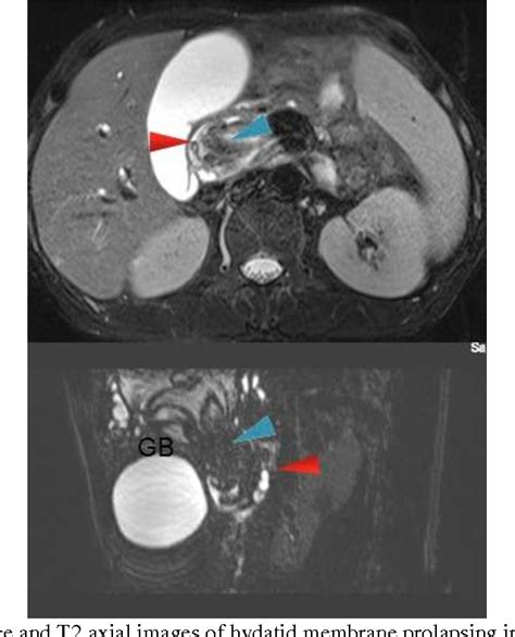 Figure 2 From Intra Biliary Rupture Of Hepatic Hydatid Cyst Presenting