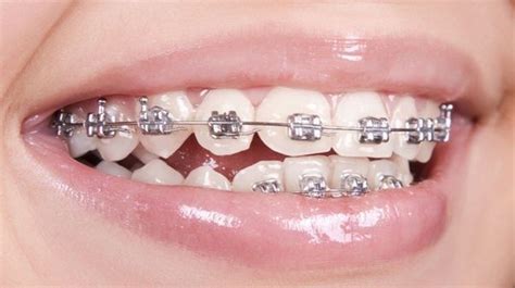 Braces Off Cute Braces Clear Braces Dental Braces Braces Teeth Colors Teeth Braces Silver