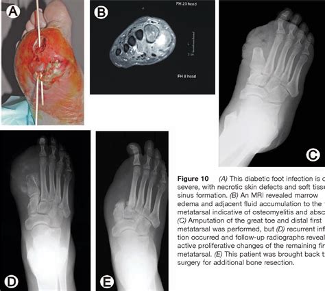 Figure 3 From Diabetic Foot Disorders A Clinical Practice Guideline