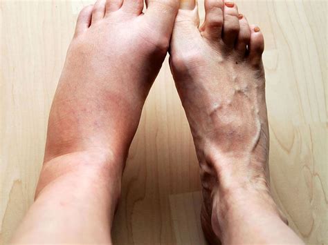 Swelling One Sign Of Inflammation Is Caused By