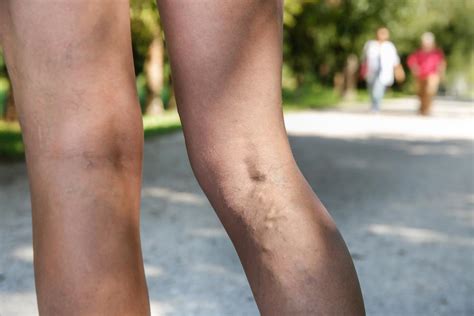 When Are Varicose Veins More Than Just A Cosmetic Concern Vein Heart