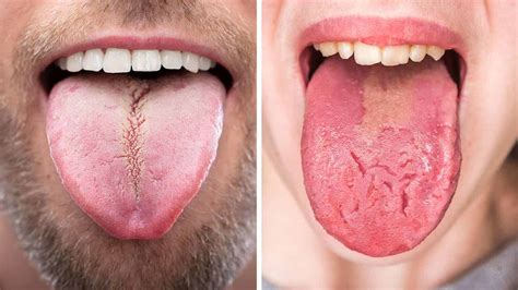 11 Things Your Tongue Can Tell You About Your Health | 6 Minute Read