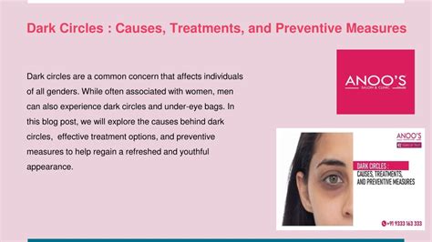 Ppt Dark Circles In Men Causes Treatments And Preventive Measures