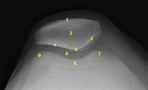 Normal Sunrise Xray Patellofemoral Joint Normal Knee Xray Anatomy