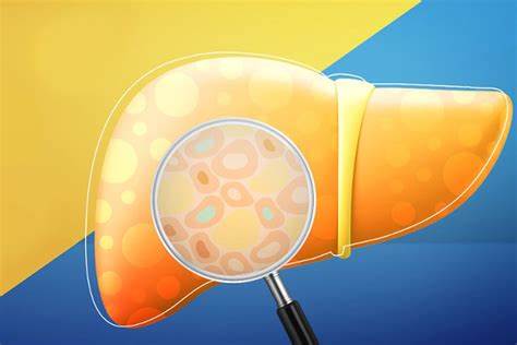 Неалкогольный жировой гепатоз диета Лечение неалкогольного жирового гепатоза и стеатогепатита Лечение неалкогольного жирового гепатоза и стеатогепатита Неалкогольный жировой гепатоз диета