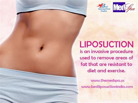 An Article For Liposuction In Delhi Importance Of Performing It Safely