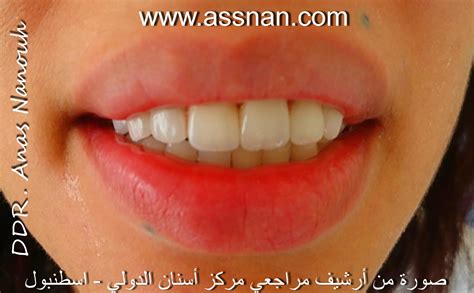 مستوصف مونتانا كلينك السالمية _ شارع حمود زيد الخالد. حالات مصورة لغرس أو زراعة أسنان كامل الفكين في مركز أسنان ...