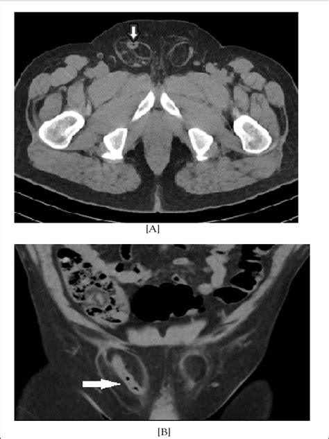 A Axial B Coronal Selected Ct Images Show Bilateral Inguinal
