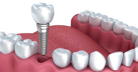 If you are missing one or more natural teeth, and. An Overview of Dental Implant Procedure Steps | Family ...