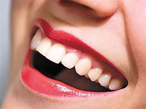 There are even cases when the patient's crown has to be replaced numerous times without definite periods. How Much Does a Dental Filling Cost Worldwide? with ...