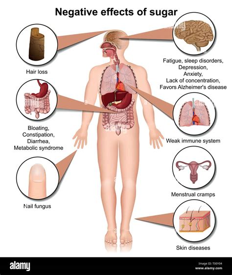Side Effects Of Sugar On The Human Body 3d Medical Vector Illustration