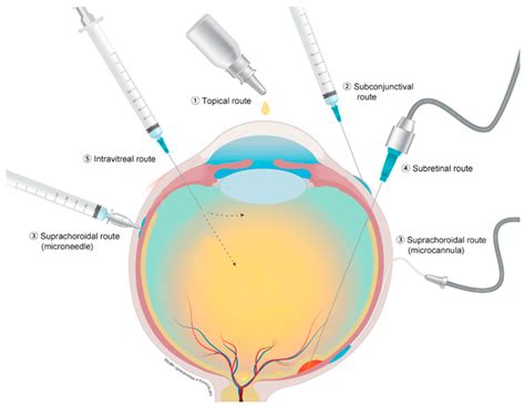 Pharmaceutics | Free Full-Text | Drug Delivery via the Suprachoroidal
