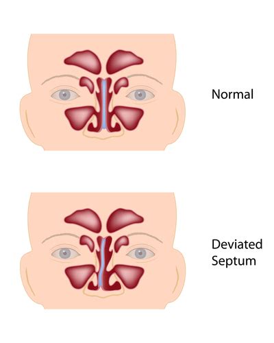 Septum deviation refers to a medical condition in which the nasal septum or the bone and cartilage that divide the nasal cavity in half, gets displaced to one side. Is My Deviated Septum Causing Sinusitis? - Sinus Infection ...