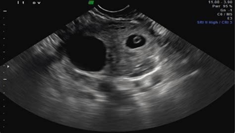 Ovarian Ectopic Pregnancy Ectopic Pregnancy A Clinical Casebook