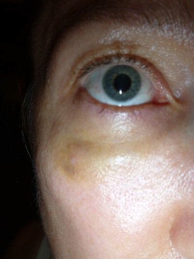 Juvederm Day 35 Will Swelling And Bruising Go Away Photo Doctor