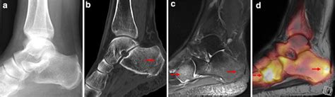 Cat scan diagnostic exams are performed to spot any unusual occurrences that are happening in the human body. X-ray (a), CT scan (b), MRI scan (c) and 18 F-Fluoride PET ...