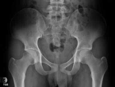 The ball and socket joint consists of two main components. Total Hip Replacement Singapore Surgeon| Safe Arthroplasty