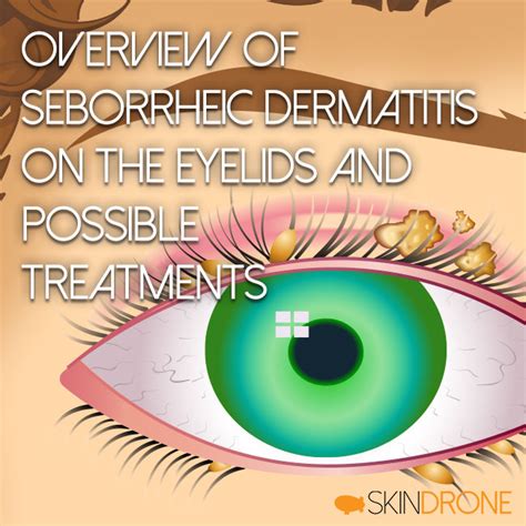 Dealing With Seborrheic Dermatitis Effecting The Eyelids Skindrone