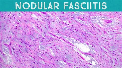 Nodular Fasciitis With Intravascular Invasion Soft Tissue Pathology