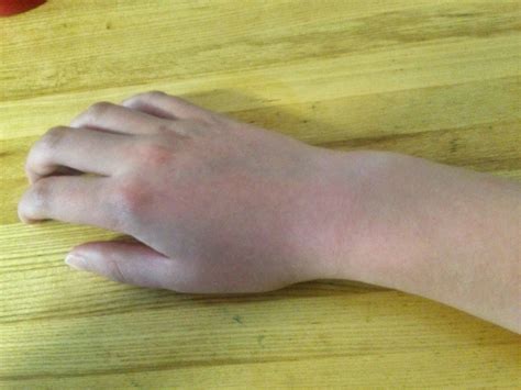 The Swollen Wrist