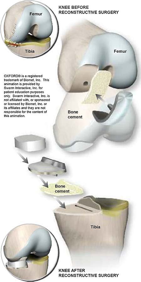 Reemplazo Parcial De Rodilla Con Implante Oxford® Grupo Médico
