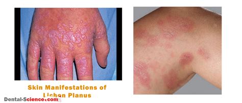 Lichen Planus Causes Symptoms Diagnosis And Treatment