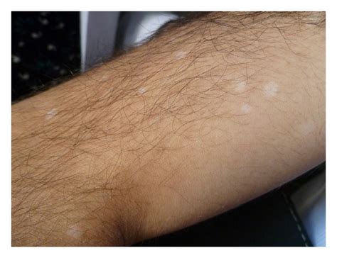 Vitiligo Lesions On The Upper Arm Of Patient Download Scientific Diagram