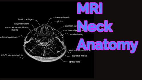 Cálculo Increíble Línea De Visión Mri Neck Anatomy Para Aumentar