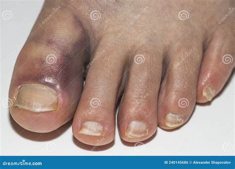 Close Up View Of Man With Damaged Foot With Bruise Big Toe Injuries