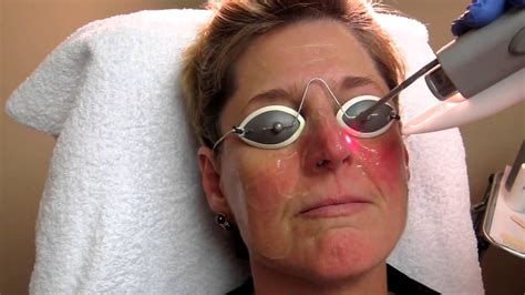 Nd Yag Laser Treatment For Rosacea At Total Body Care Youtube
