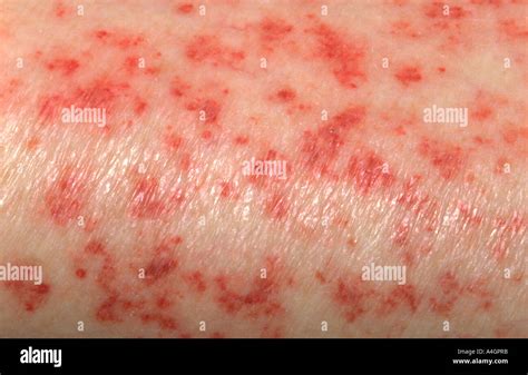 Skin Rash In Aplastic Anaemia Stock Photo Alamy