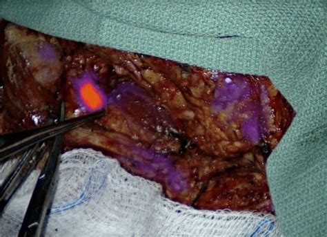 Tumor Dye Makes Cancerous Lymph Nodes Glow During Surgery • Healthcare