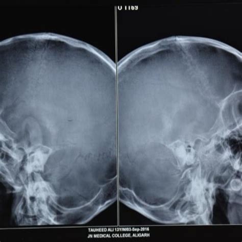 Pdf Radiographic Imaging Of Mastoid In Chronic Otitis Media Need Or