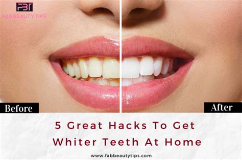 5 Great Hacks To Get Whiter Teeth At Home Fab Beauty Tips