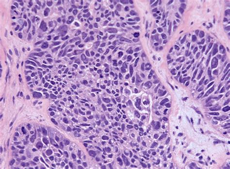 Pathology Outlines High Grade Serous Carcinoma